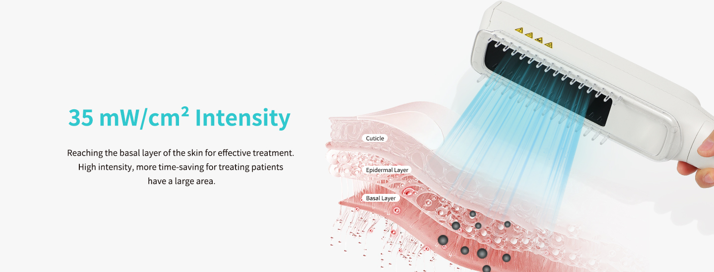 vitiligo lamp vitiligo lamp