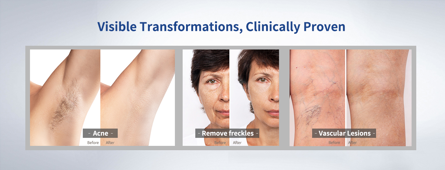 Pigmented Lesions laser machine