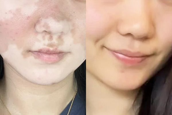 Vitiligo Treatment