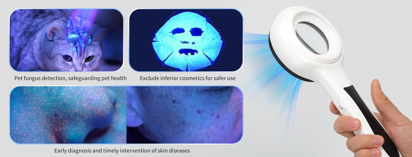 Woods Lamp for Vitiligo