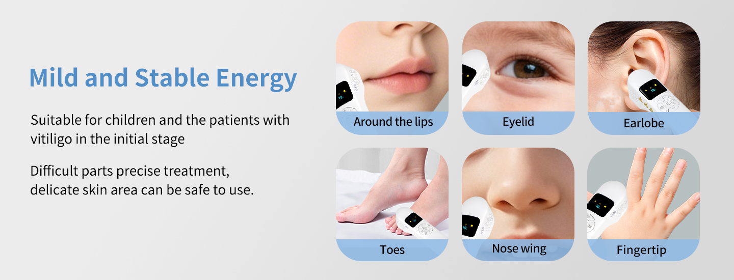 Narrowband UVB Phototherapy