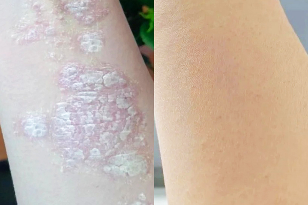 Psoriasis Treatment