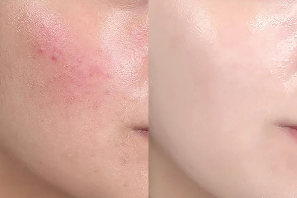 Eczema Treatment