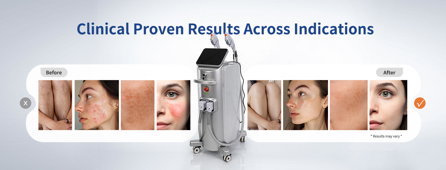 OPT Phototherapy System