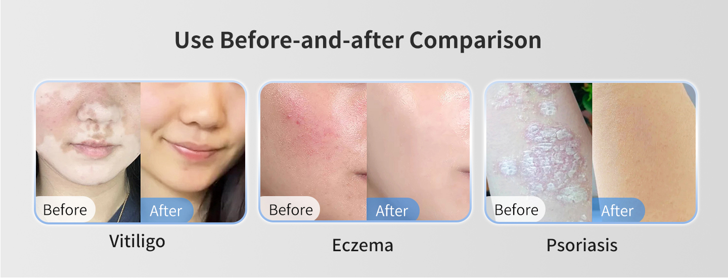 UV Light Therapy for Skin Diseases