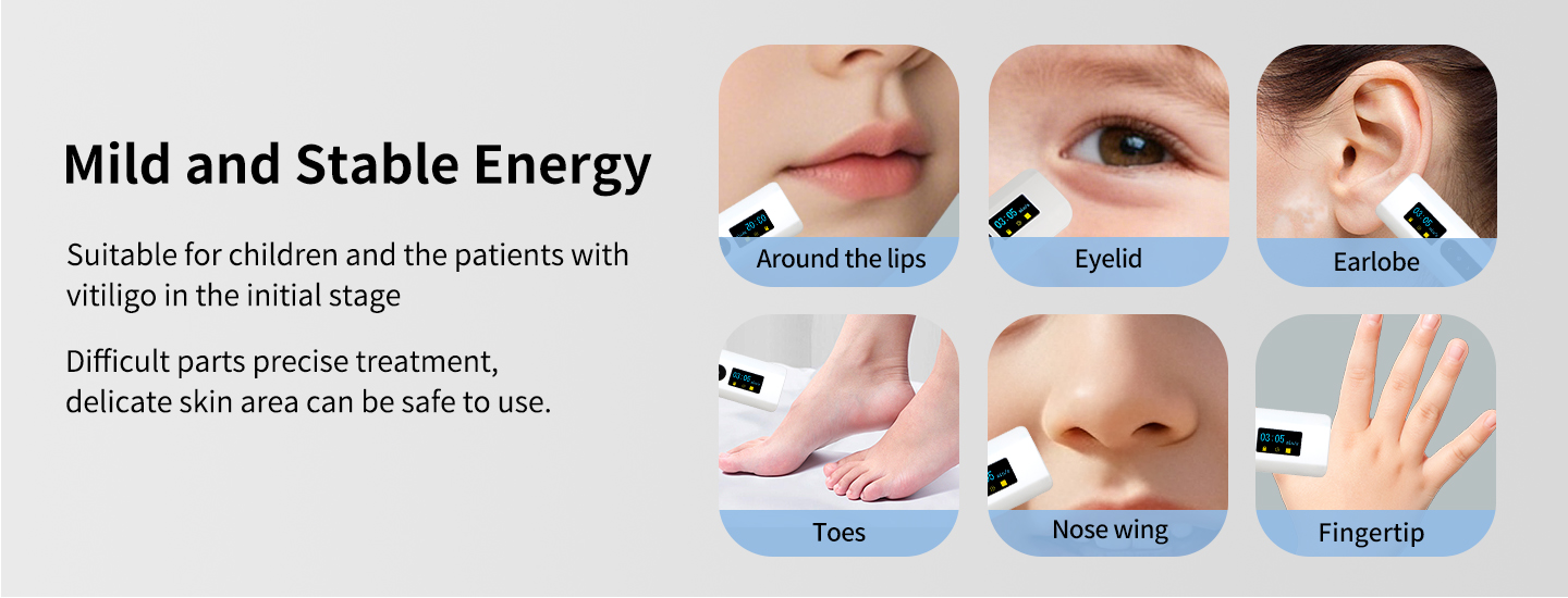 Phototherapy for Vitiligo at Home